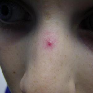facial vein laser treatment