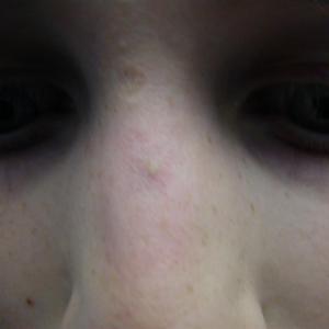 spider veins laser treatment