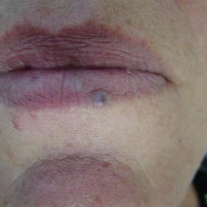 facial vein treatment
