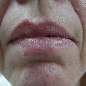 facial vein laser treatment before and after