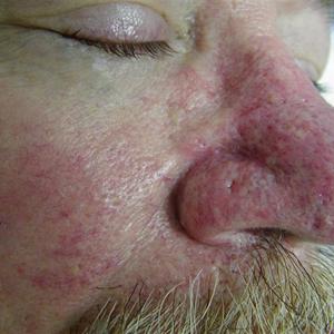 laser treatment for nose