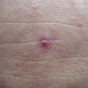 laser spider vein treatment