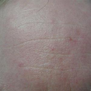 laser spider vein removal