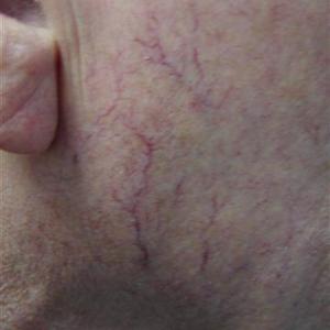laser vein treatment face