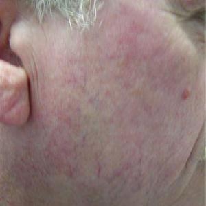 best treatment for facial veins