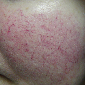 laser treatment for facial vein