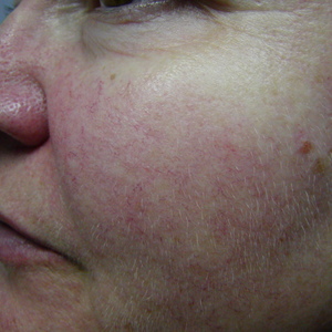 treating facial vein