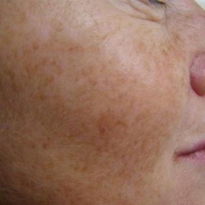 ipl skin treatment