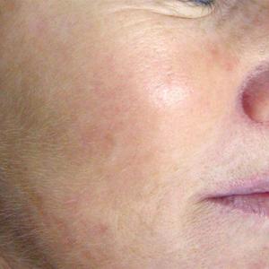 ipl laser treatment
