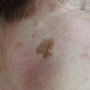 ipl treatment for face