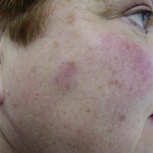 ipl treatment