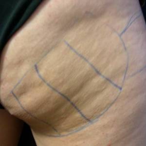 cellulite treatments