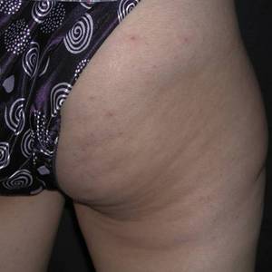 cellulite laser treatment