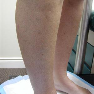 sclerotherapy recovery image