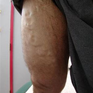 sclerotherapy varicose veins