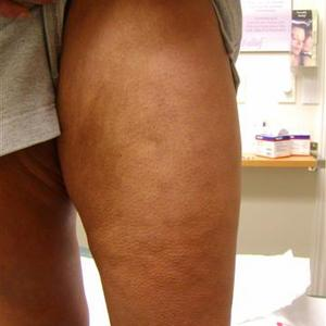sclerotherapy pictures